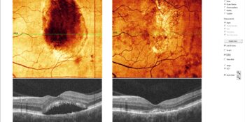 MICROPULSE LASER